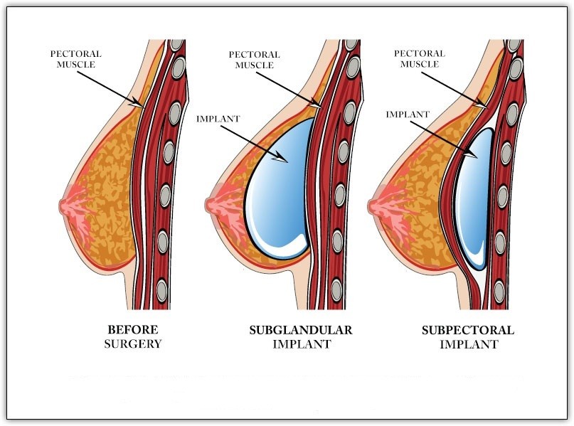 Breast augmentation and reduction image