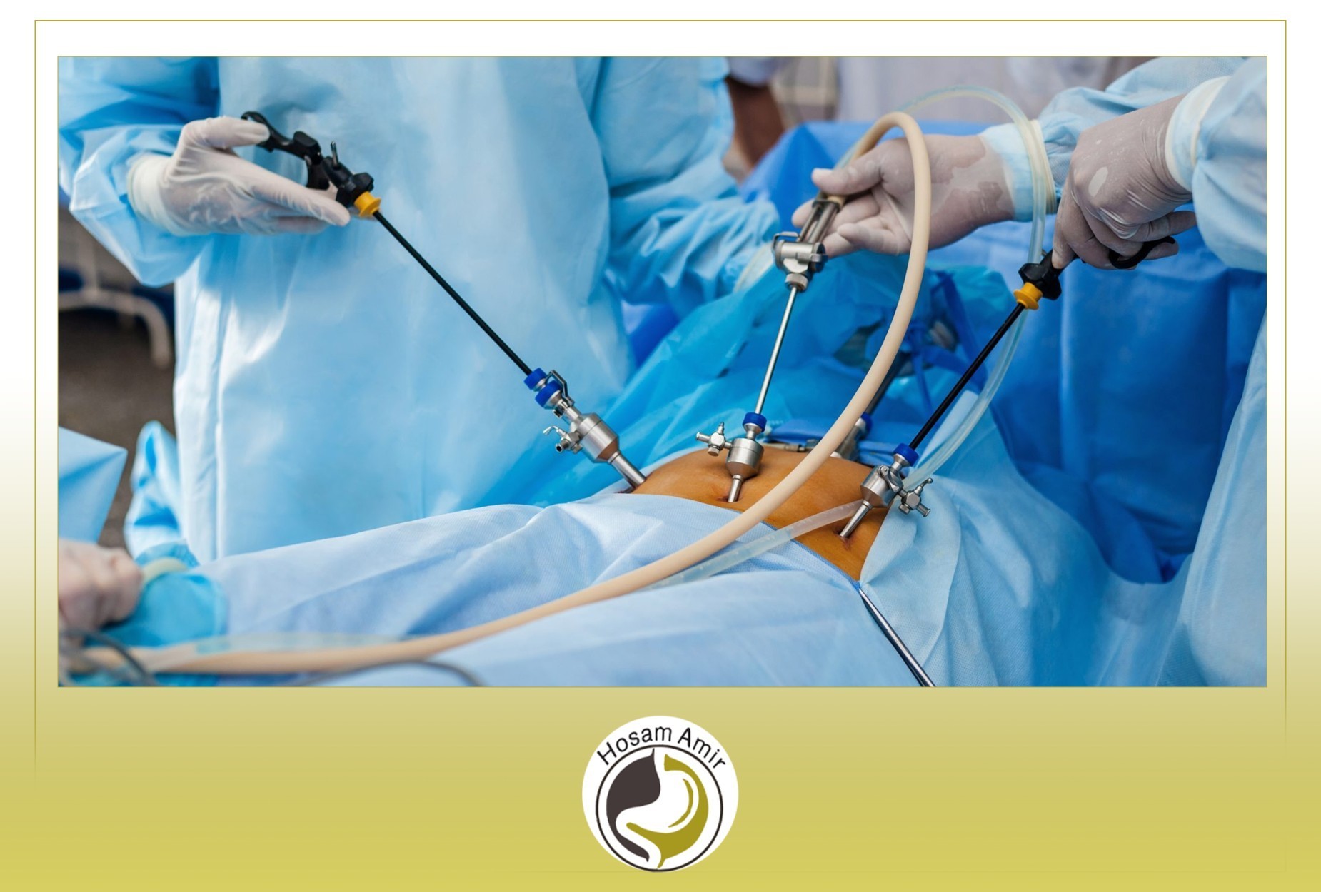 عمليه الزائدة بالمنظار image