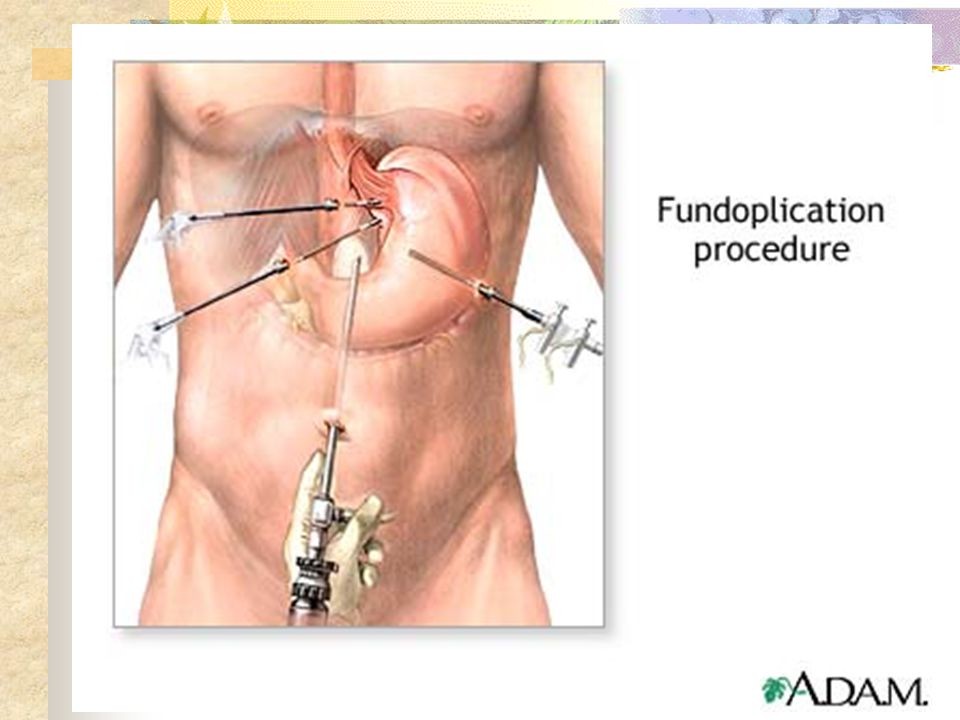 Laparoscopic hiatal hernia repair image
