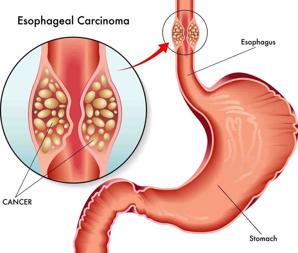 Gastric and esophageal tumor resection image