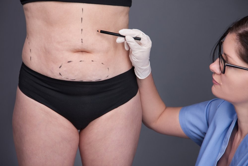 4D liposuction image